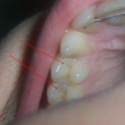 Petits trous, fissures sur prmolaires et molaires Dents10