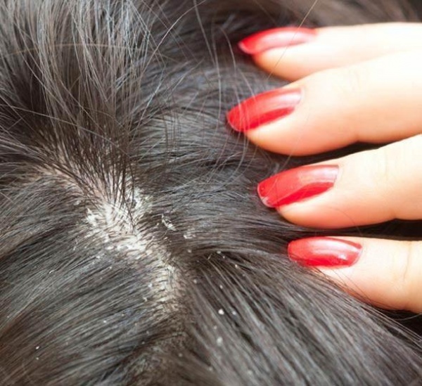 7 علاجات منزلية تساعد فى منع تساقط الشعر بسبب القشرة  9774_110