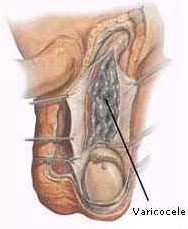 سبب من اسباب اعقم عند الرجال2- أسباب تتعلق بالخصيتين Testicular Disorders Untitl11