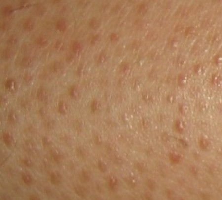 الأسباب والعلاج لـ نمو الشعر تحت الجلد Ska10