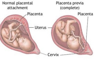 Rèsumè sur placenta praevia  Img_3311