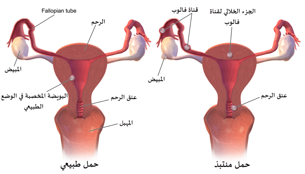 شرح مصور لعملية تخصيب البويضه والحمل عند المرإة Ectopi10