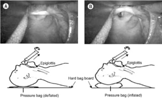 [astuce]:Les secrets d’une intubation réussie Kjae-510