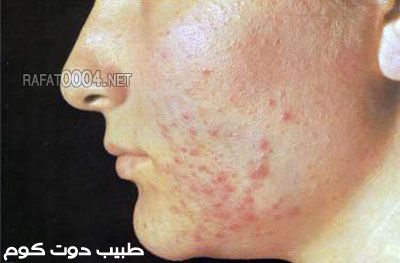 حب الشباب Acne  Pic-8910