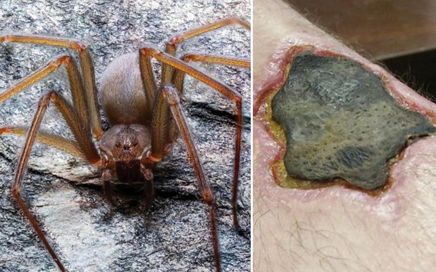Nécrose et amputation: ne vous fiez pas à la petite taille de cette nouvelle araignée 115