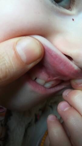 Chute Dent De Lait Enfoncee Besoin Conseil