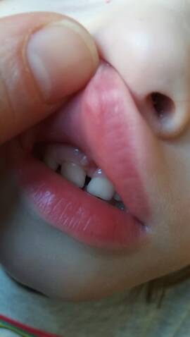 Chute Dent De Lait Enfoncee Besoin Conseil