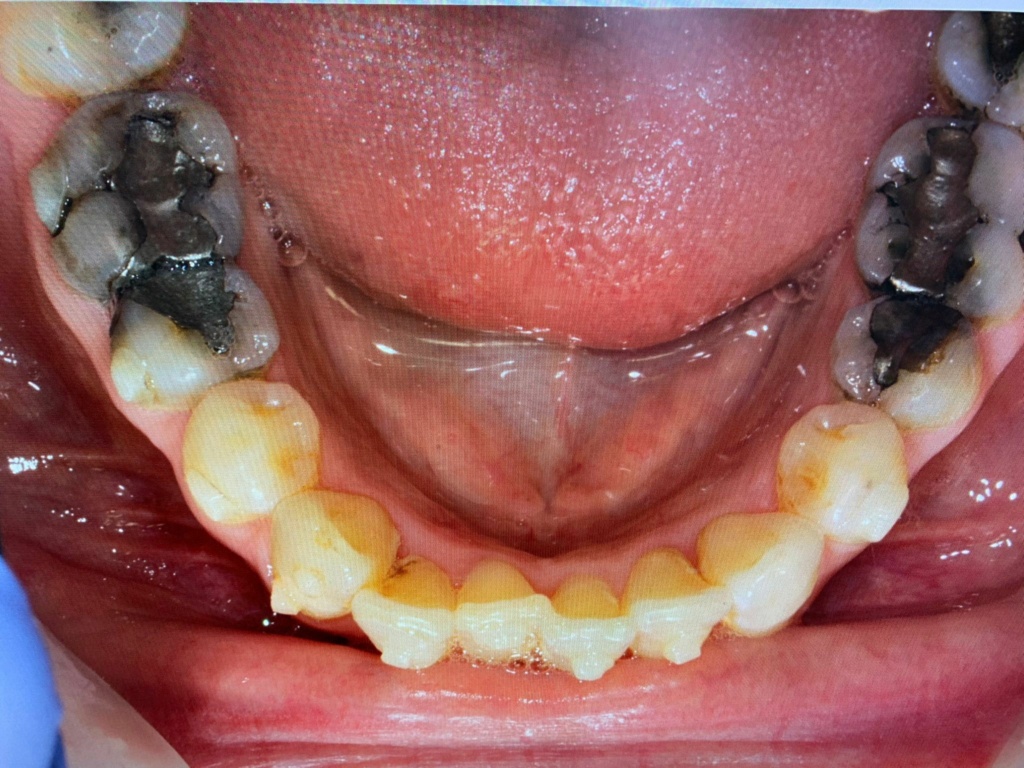 R Payne aligner patient 7b9fa011