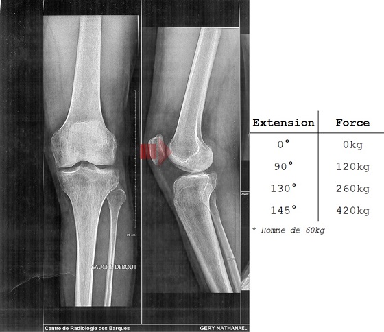 Compréhension du syndrome fémoro-patellaire Tensio11