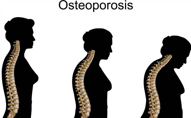 Langkah cegah osteoporosis buat wanita 49808110