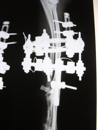 Trattamento di una frattura diafisaria di radio-ulna Vega_p13