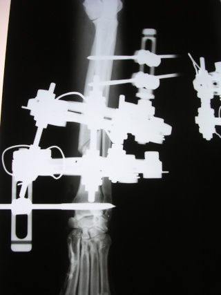 Trattamento di una frattura diafisaria di radio-ulna Vega_p14