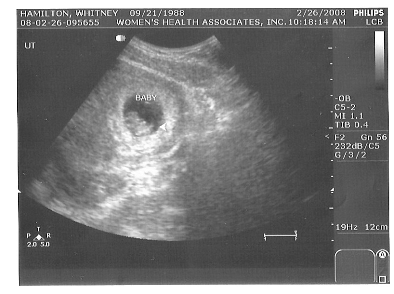Ultrasound Pictures Us_1a10