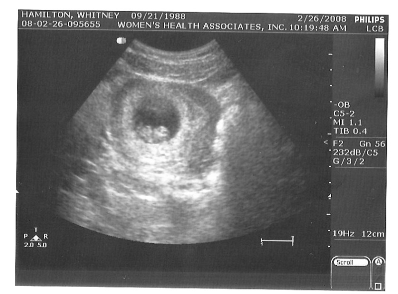 Ultrasound Pictures Us_1b10