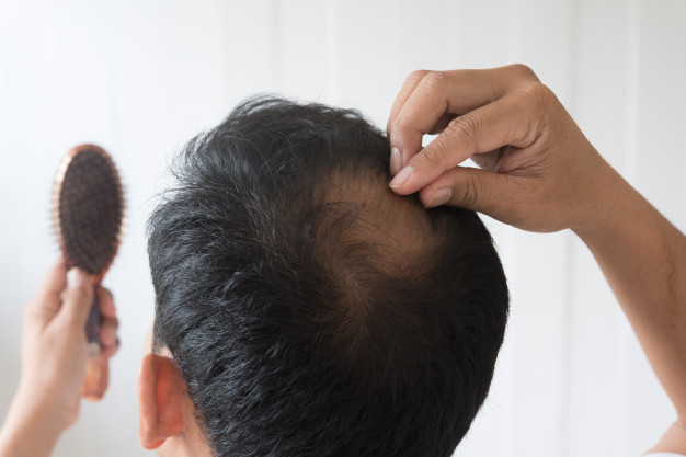علاج تساقط الشعر عند الرجال بطرق طبيعية امنه 2020 412