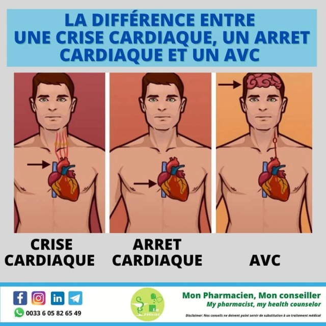 Différence en crise cardiaque, arrêt cardiaque et AVC Diffzo10