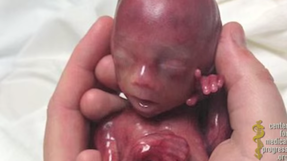 SEVENTH PLANNED PARENTHOOD EXPOSE': SOME BABIES ARE ALIVE WHEN ORGANS ARE HARVESTED Baby10