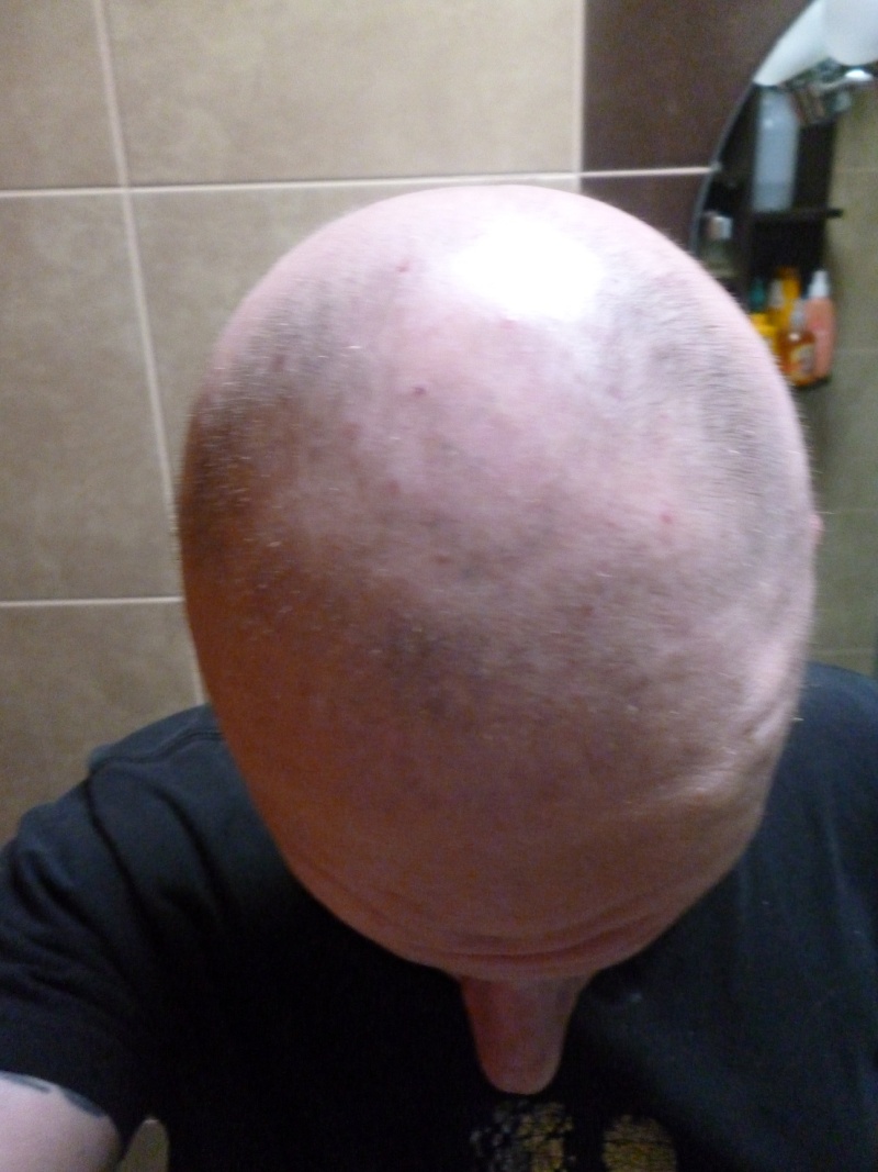 Yo-alopecia areata universal- ANTES Y DESPUES...PROTESIS CAPILAR TOTAL FRENCH LACE. Primo_10