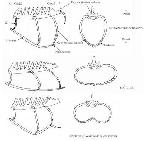 Diagnostiquer Le Syndrome Des Cotes Plates