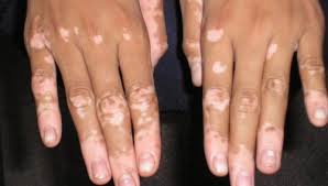 Tunisie: Traitement de la maladie de Vitiligo - Un chercheur tunisien conçoit un traitement Brass11