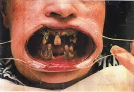 Récupération de matériel dentaire pour le modélisme Dents_10