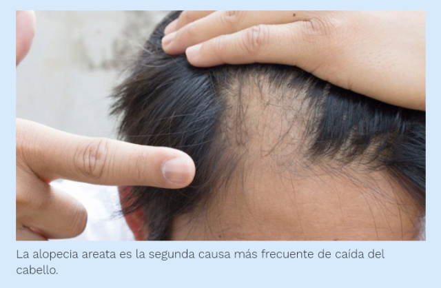 Los expertos avalan un tratamiento para la alopecia en adolescentes Scree306