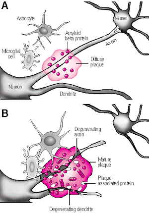 Alzheimer's Disease: Molecular Imaging For Early Detection May Be Available In Hospitals Within 1 Year Alzhei10