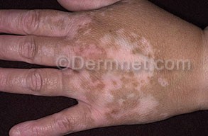 Vitiligo - bele mrlje po koži Vitili10