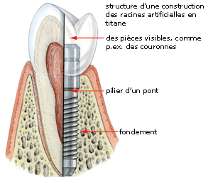 Les implants dentaires Aufbau10