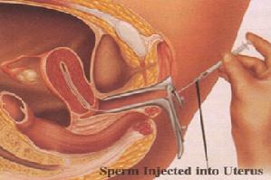 IUI (Inseminacija) Insemi11