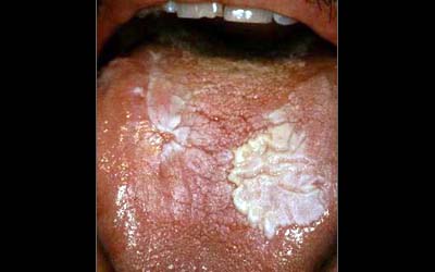 Pathologie de la muqueuse buccale: leucoplasie, aphtes, Maladie de Kaposi  810