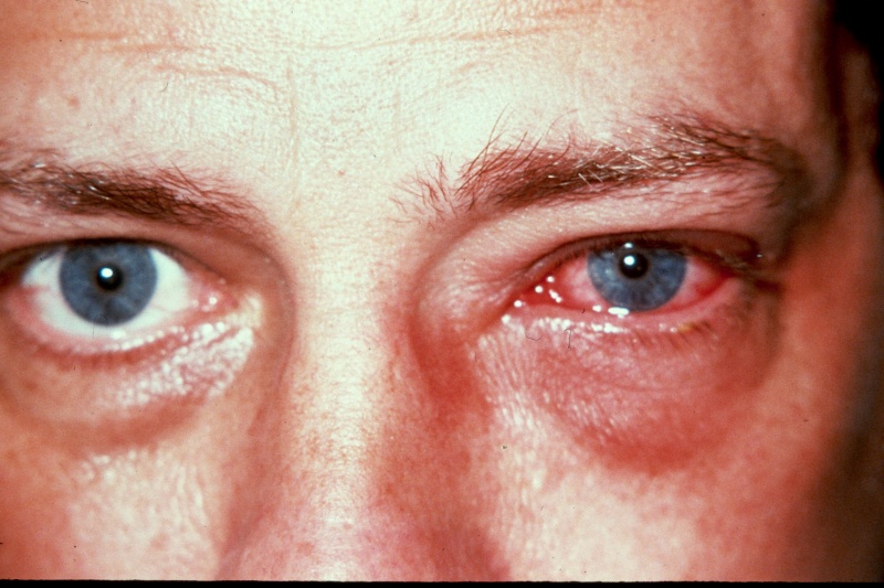 التهاب الملتحمة ( العين الوردية ) : الأعراض والعلاج والوقاية 111