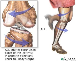 إصابات الرباط الصليبي والغضروف الهلالي تسبب خشونة الركبة  Palnur10