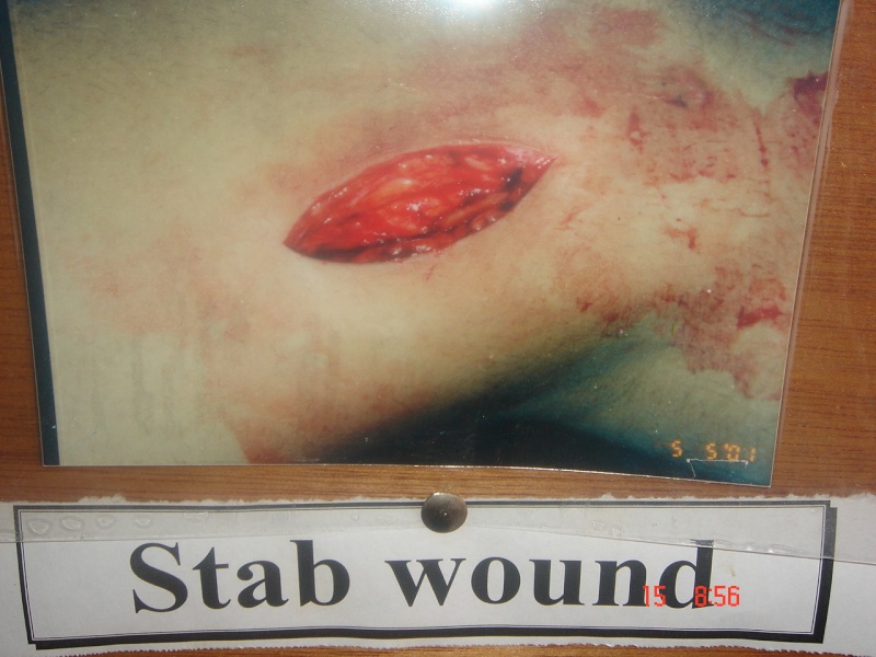 Wounds  ( incised wounds 0 Forens10