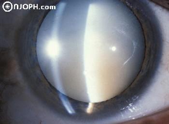 Spot diagnosis of ophthalmology Hyperm10