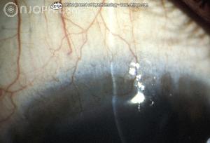 Spot diagnosis of ophthalmology Tracho11