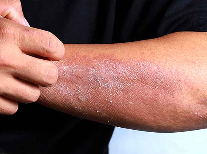 Conséquences de la dermite sur la peau Dermit11