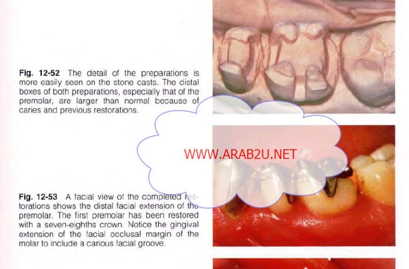 Tooth Preparation 9-9-2012