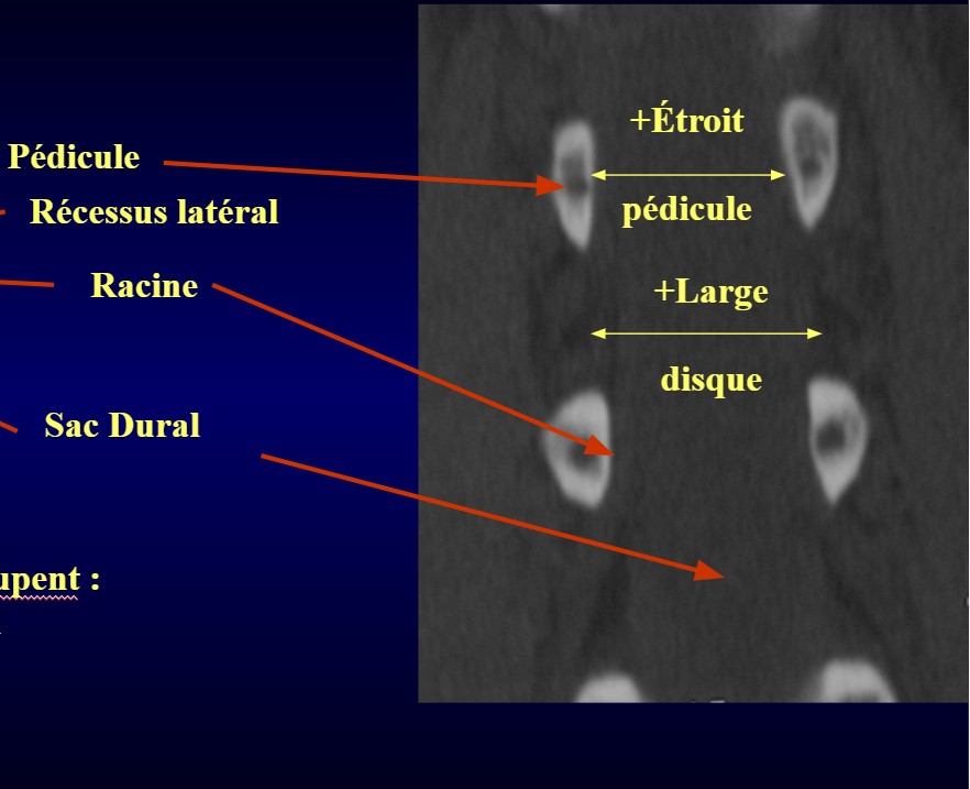 Foramen spinal Captur36