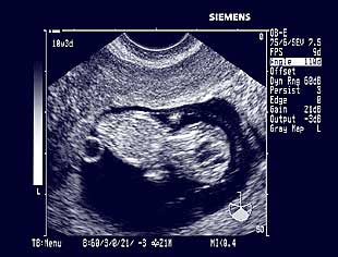 bebe - Razvoj bebe od I do XL nedelje trudnoće 1010