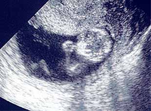bebe - Razvoj bebe od I do XL nedelje trudnoće 1310