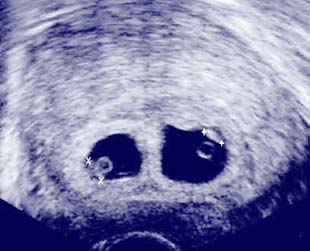 bebe - Razvoj bebe od I do XL nedelje trudnoće 511