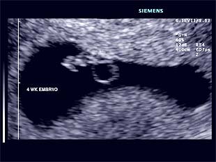 bebe - Razvoj bebe od I do XL nedelje trudnoće 610