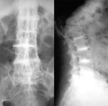 Spinal and Peripheral Arthropathy Ochron10