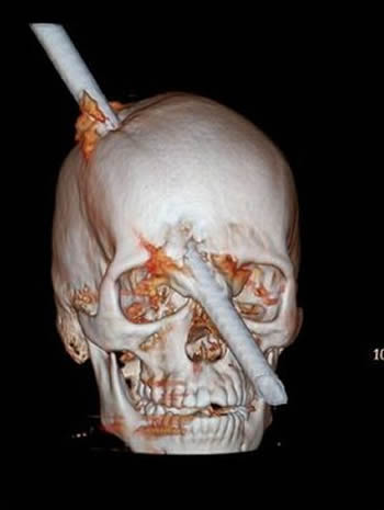 Una barra de acero le atraviesa el cráneo y vive para contarla Leite210