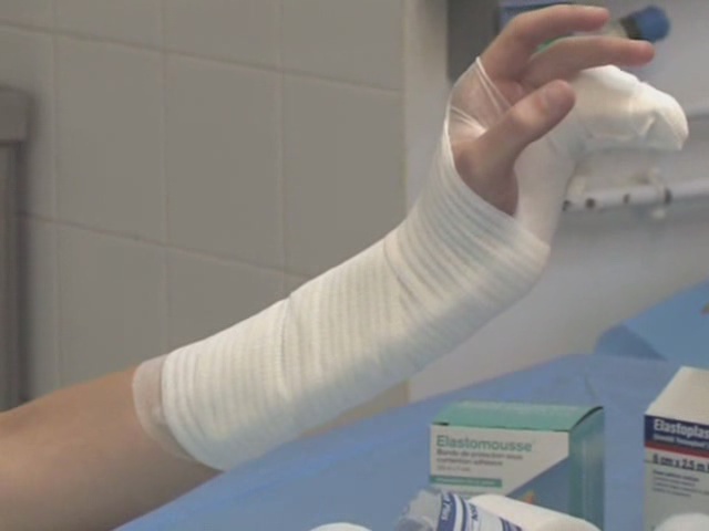 (Vidéo) Attelle de fracture du  5 ème metacarpien. Platr410