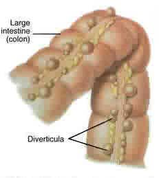 Diverticulitis Diveri10