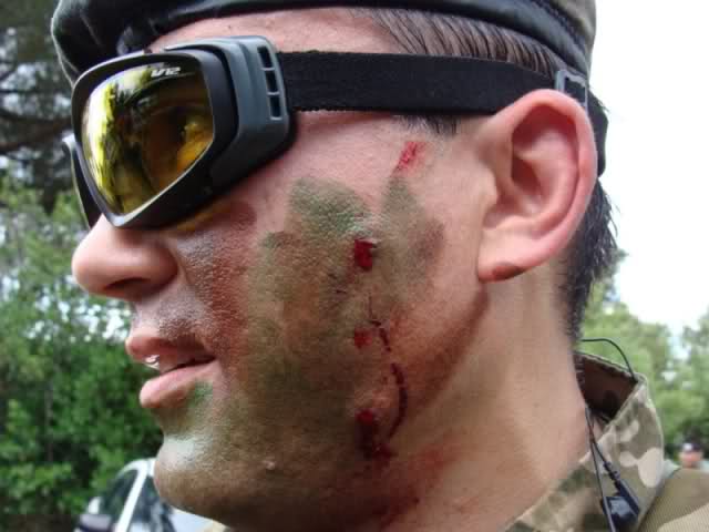 Airsoft injury pictures Dh3i2v10