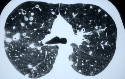 L'histiocytose pulmonaire primitive chez l'adulte Emchx110
