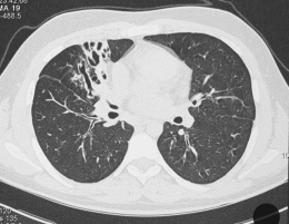 Les maladies orphelines: un nouveau défi pour la santé publique Thorax10